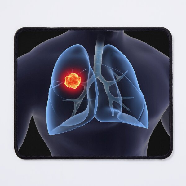 Item preview, STK701433H-Lung cancer inside the human lungs. designed and sold by StocktrekImages.