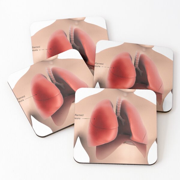 Item preview, STK701434H-Pleurisy in the human lungs. designed and sold by StocktrekImages.