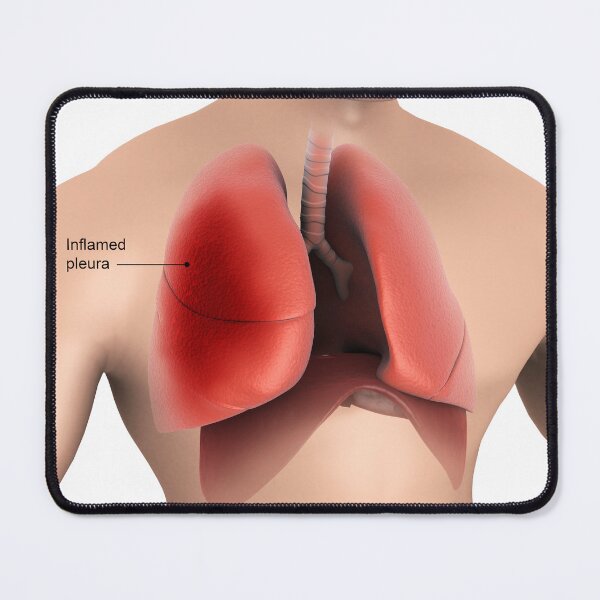 Item preview, STK701434H-Pleurisy in the human lungs. designed and sold by StocktrekImages.