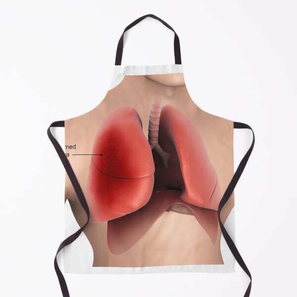 Item preview, STK701434H-Pleurisy in the human lungs. designed and sold by StocktrekImages.