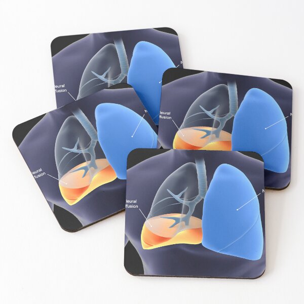 Item preview, STK701435H-Pleurisy in the human lungs. designed and sold by StocktrekImages.