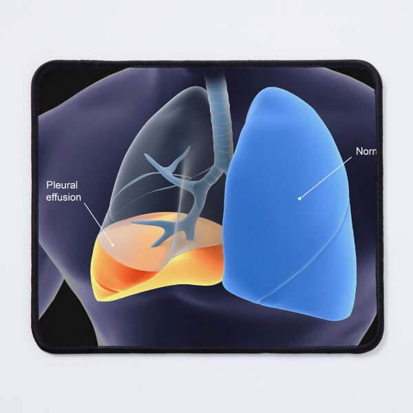 Item preview, STK701435H-Pleurisy in the human lungs. designed and sold by StocktrekImages.