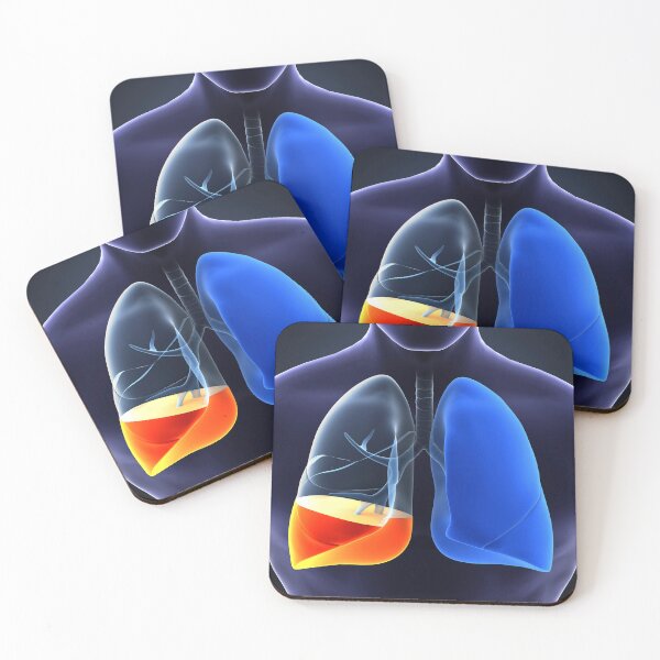 Item preview, STK701436H-Pneumonia in the human lungs. designed and sold by StocktrekImages.