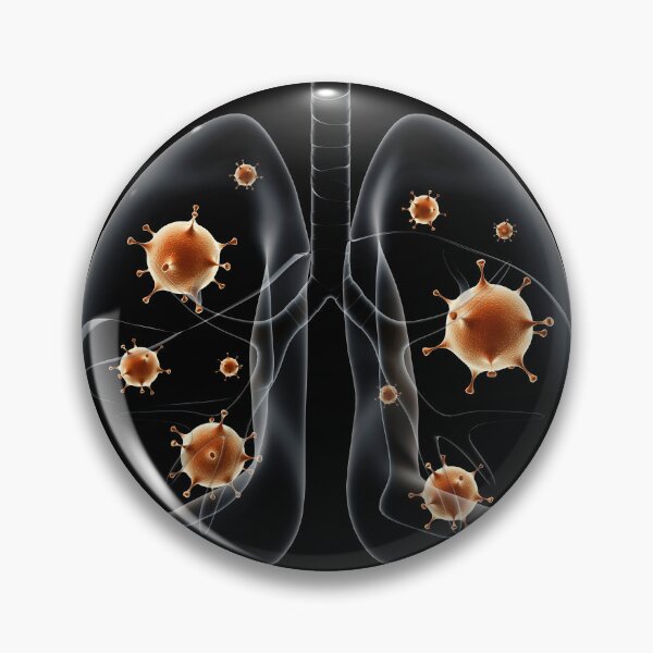 Item preview, STK701438H-Pneumonia in the human lungs. designed and sold by StocktrekImages.