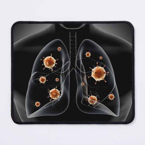Item preview, STK701438H-Pneumonia in the human lungs. designed and sold by StocktrekImages.