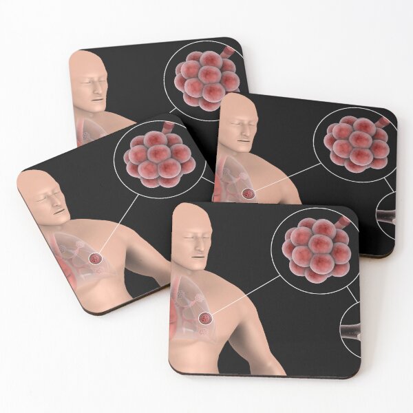 Item preview, STK701439H-Pneumonia in the alveolus of human lungs. designed and sold by StocktrekImages.