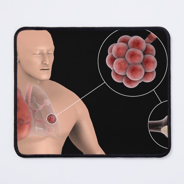 Item preview, STK701439H-Pneumonia in the alveolus of human lungs. designed and sold by StocktrekImages.