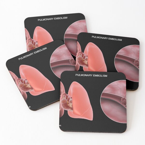Item preview, STK701440H-Pulmonary embolism in the human lungs. designed and sold by StocktrekImages.