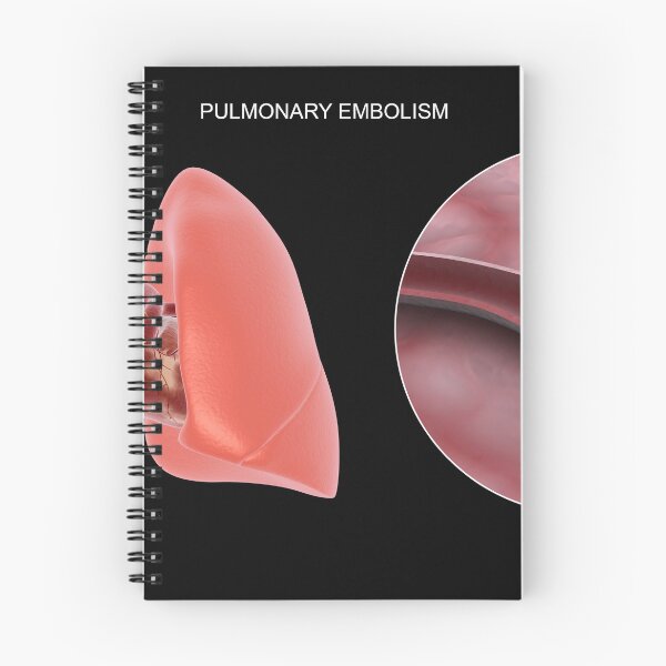 Item preview, STK701440H-Pulmonary embolism in the human lungs. designed and sold by StocktrekImages.