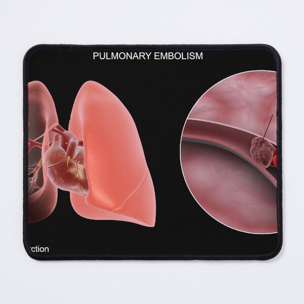 Item preview, STK701440H-Pulmonary embolism in the human lungs. designed and sold by StocktrekImages.
