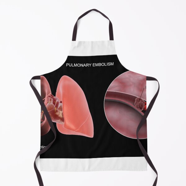 Item preview, STK701440H-Pulmonary embolism in the human lungs. designed and sold by StocktrekImages.