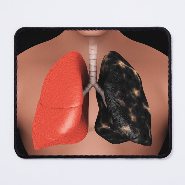 Item preview, STK701442H-Pulmón sano versus pulmón de fumador. designed and sold by StocktrekImages.