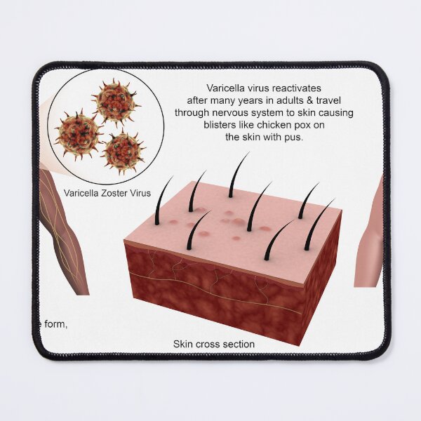 Item preview, STK701446H-Shingles caused by the varicella-zoster virus. designed and sold by StocktrekImages.