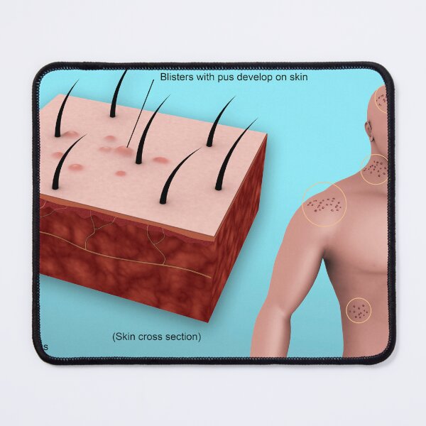 Item preview, STK701448H-Shingles caused by the varicella-zoster virus. designed and sold by StocktrekImages.