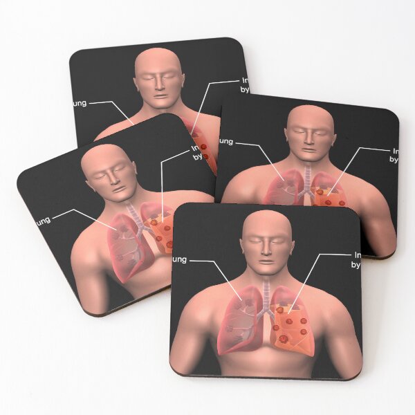 Item preview, STK701492H-COVID-19 coronavirus infecting the human lungs, with labels. designed and sold by StocktrekImages.