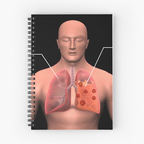 Item preview, STK701492H-COVID-19 coronavirus infecting the human lungs, with labels. designed and sold by StocktrekImages.