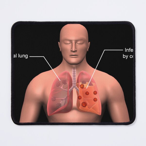 Item preview, STK701492H-COVID-19 coronavirus infecting the human lungs, with labels. designed and sold by StocktrekImages.