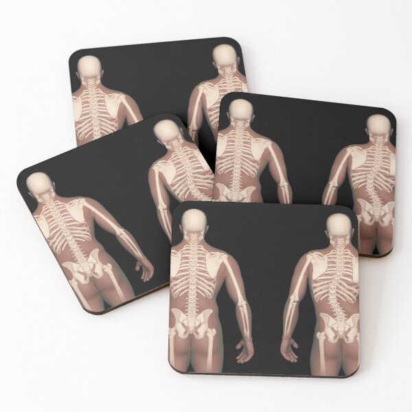 Item preview, STK701550H-Normal human spine vs. a spine with scoliosis. designed and sold by StocktrekImages.