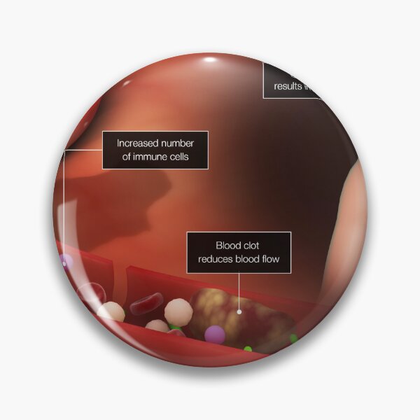 Item preview, STK701551H-Sepsis in the bloodstream designed and sold by StocktrekImages.