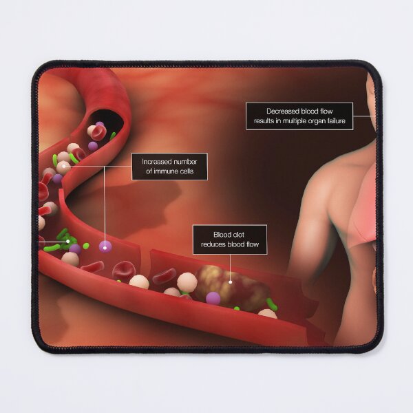 Item preview, STK701551H-Sepsis in the bloodstream designed and sold by StocktrekImages.