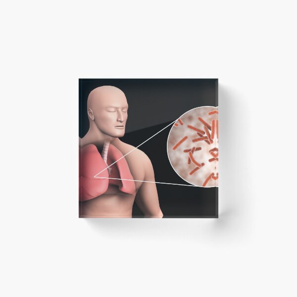 Item preview, STK701552H-Tuberculosis in the human lungs. designed and sold by StocktrekImages.