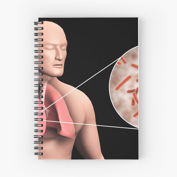 Item preview, STK701552H-Tuberculosis in the human lungs. designed and sold by StocktrekImages.