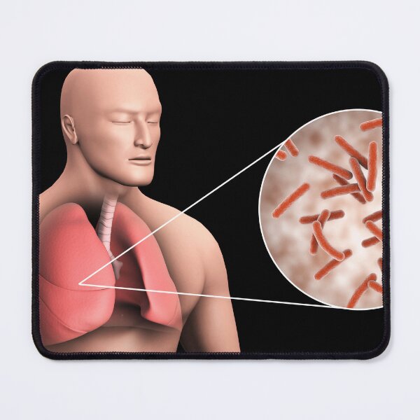 Item preview, STK701552H-Tuberculosis in the human lungs. designed and sold by StocktrekImages.
