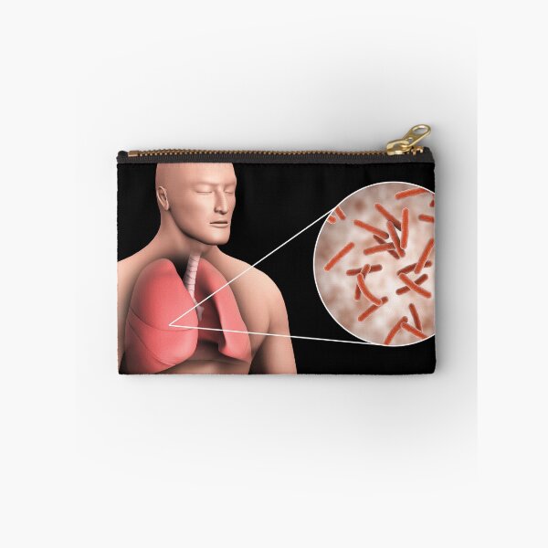 Item preview, STK701552H-Tuberculosis in the human lungs. designed and sold by StocktrekImages.