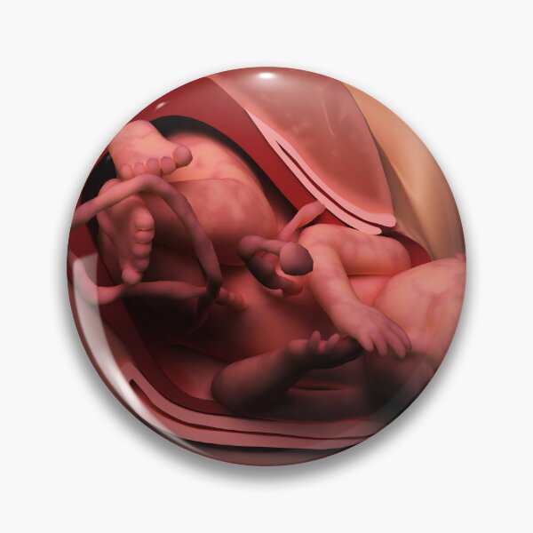 Item preview, STK701561H-Delivery of fetus in womb. designed and sold by StocktrekImages.
