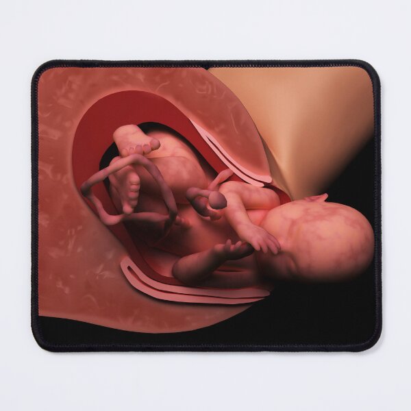 Item preview, STK701561H-Delivery of fetus in womb. designed and sold by StocktrekImages.