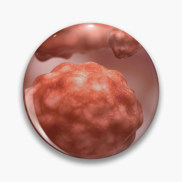 Item preview, STK701591H-Fungal infection cryptococcosis. designed and sold by StocktrekImages.