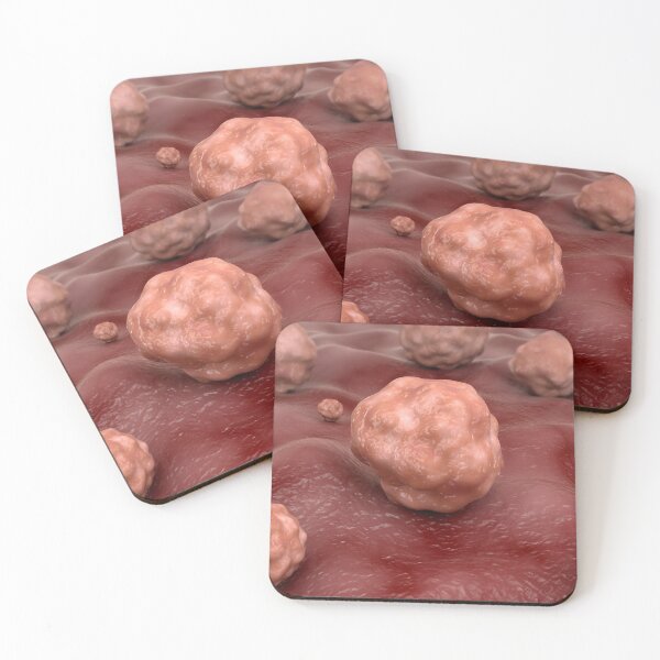 Item preview, STK701592H-Fungal infection cryptococcosis. designed and sold by StocktrekImages.