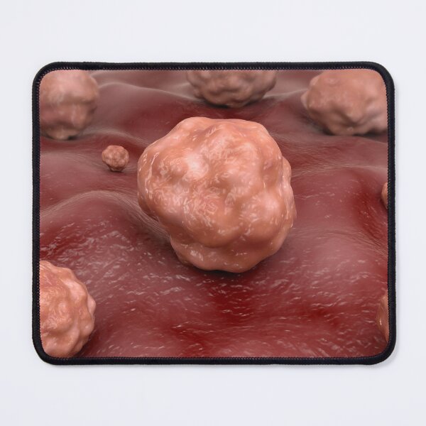 Item preview, STK701592H-Fungal infection cryptococcosis. designed and sold by StocktrekImages.