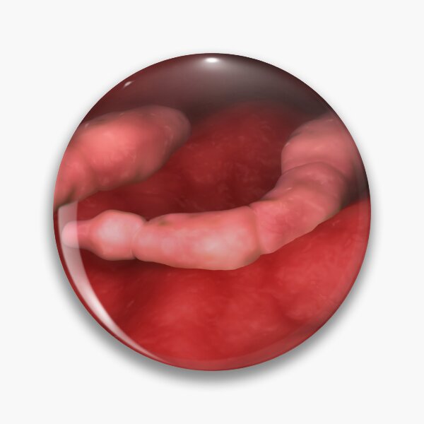 Item preview, STK701593H-Echinococcus parasites inside the liver. designed and sold by StocktrekImages.