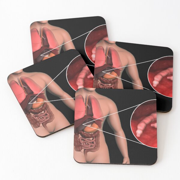 Item preview, STK701594H-Echinococcus parasites inside the liver. designed and sold by StocktrekImages.