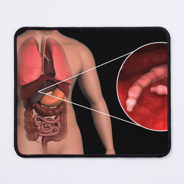 Item preview, STK701594H-Echinococcus parasites inside the liver. designed and sold by StocktrekImages.
