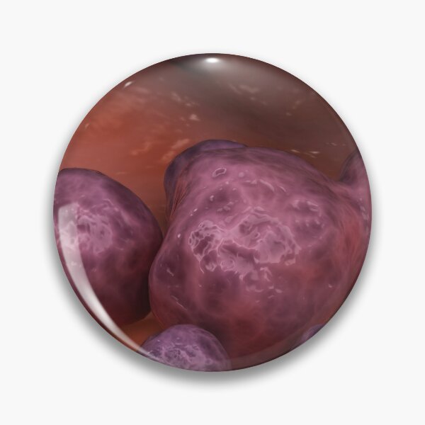 Item preview, STK701647H-Paracoccidioidomycosis fungal infection. designed and sold by StocktrekImages.