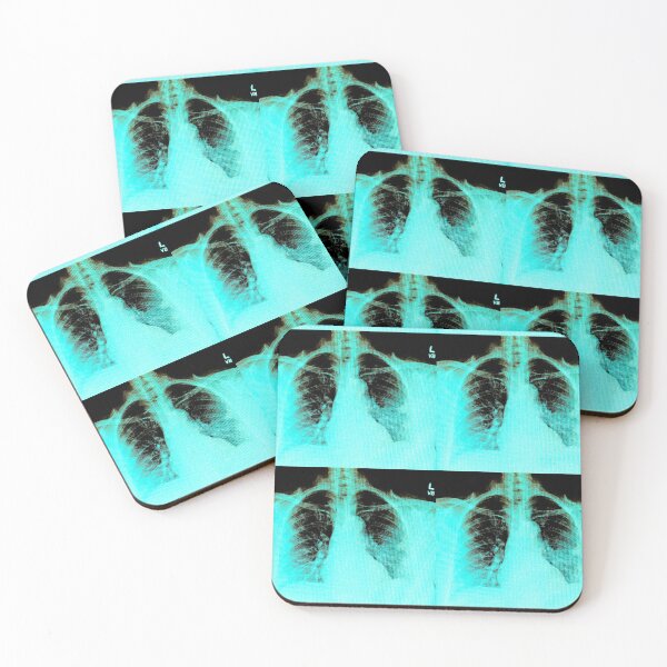 Item preview, Chest X-ray of Patient with COVID-19 Infection designed and sold by Creative Endeavors ..