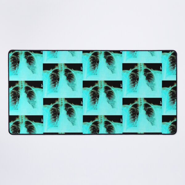 Item preview, Chest X-ray of Patient with COVID-19 Infection designed and sold by Creative Endeavors ..