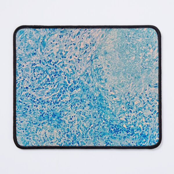 Item preview, Histology of Tuberculosis of the lung, TB, human tissue, Ziehl-Neelsen stain, 20x designed and sold by Psymier.