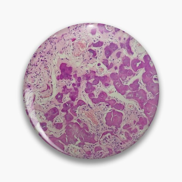 Item preview, Histology of coalescing psammomatous calcification, human tissue, H&E, 20x designed and sold by Psymier.