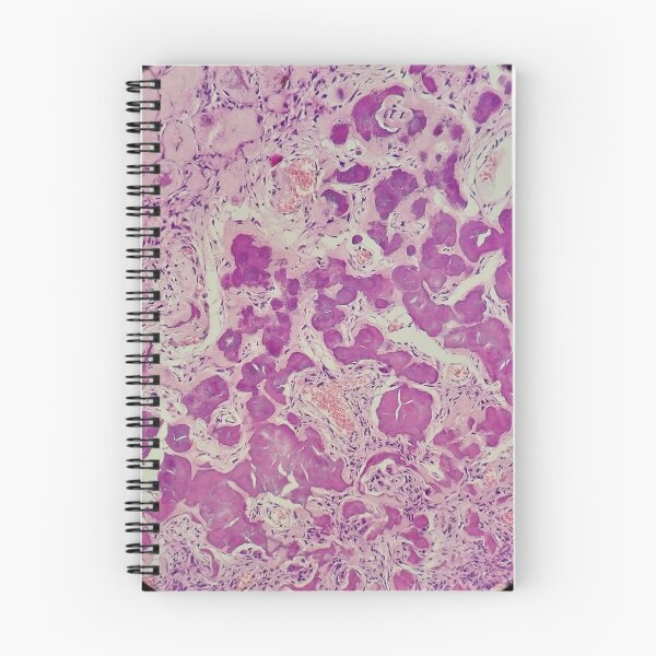 Item preview, Histology of coalescing psammomatous calcification, human tissue, H&E, 20x designed and sold by Psymier.