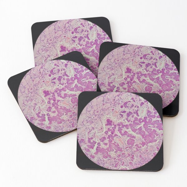 Item preview, Histology of coalescing psammomatous calcification, human tissue, H&E, 20x designed and sold by Psymier.