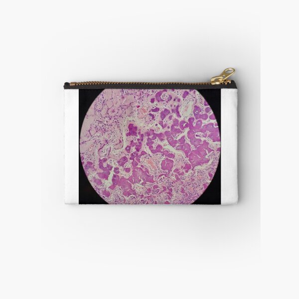 Item preview, Histology of coalescing psammomatous calcification, human tissue, H&E, 20x designed and sold by Psymier.