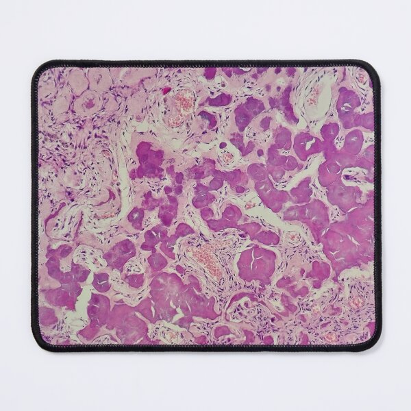 Item preview, Histology of coalescing psammomatous calcification, human tissue, H&E, 20x designed and sold by Psymier.