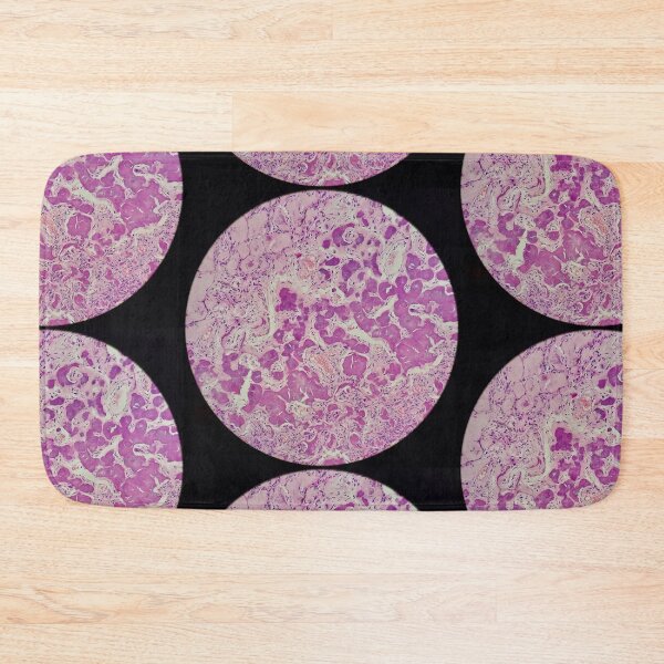 Item preview, Histology of coalescing psammomatous calcification, human tissue, H&E, 20x designed and sold by Psymier.