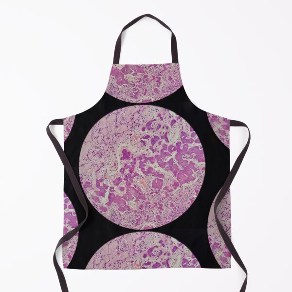 Item preview, Histology of coalescing psammomatous calcification, human tissue, H&E, 20x designed and sold by Psymier.