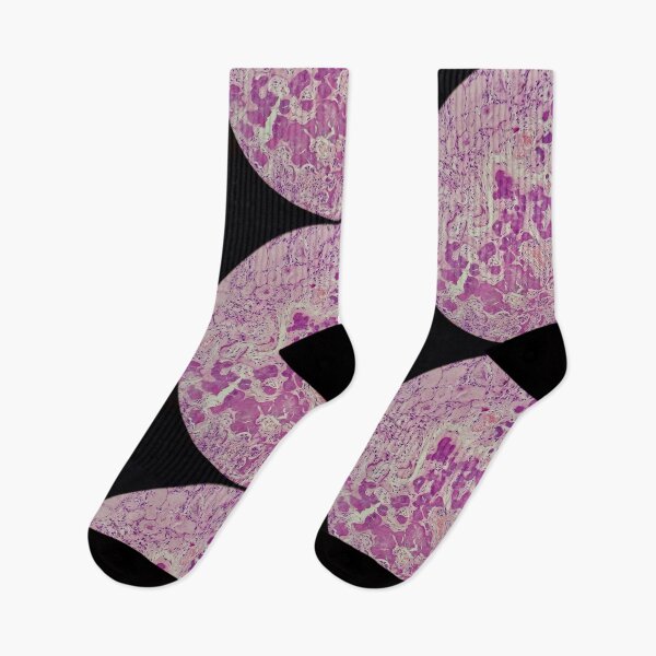 Item preview, Histology of coalescing psammomatous calcification, human tissue, H&E, 20x designed and sold by Psymier.