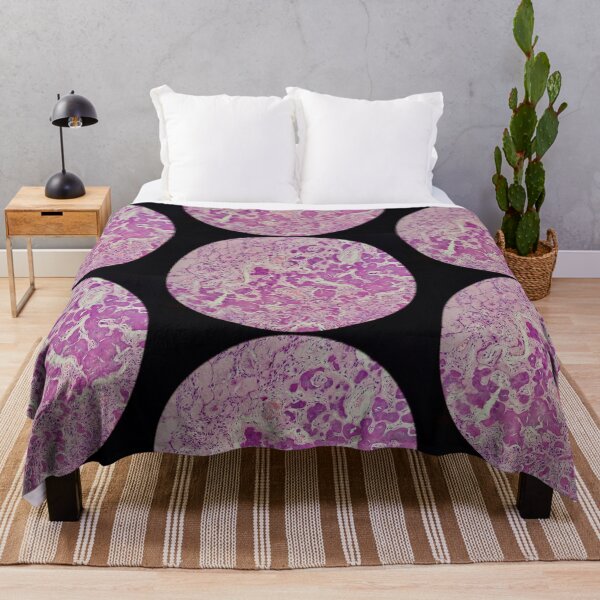 Item preview, Histology of coalescing psammomatous calcification, human tissue, H&E, 20x designed and sold by Psymier.