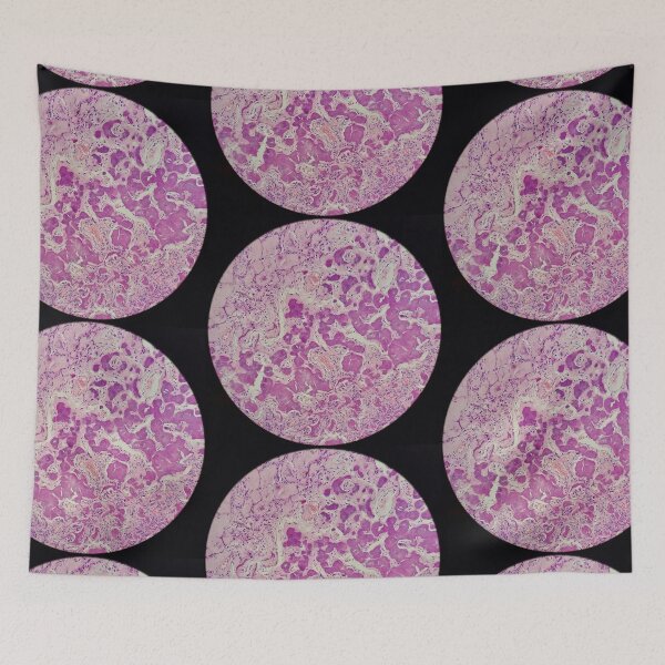 Item preview, Histology of coalescing psammomatous calcification, human tissue, H&E, 20x designed and sold by Psymier.